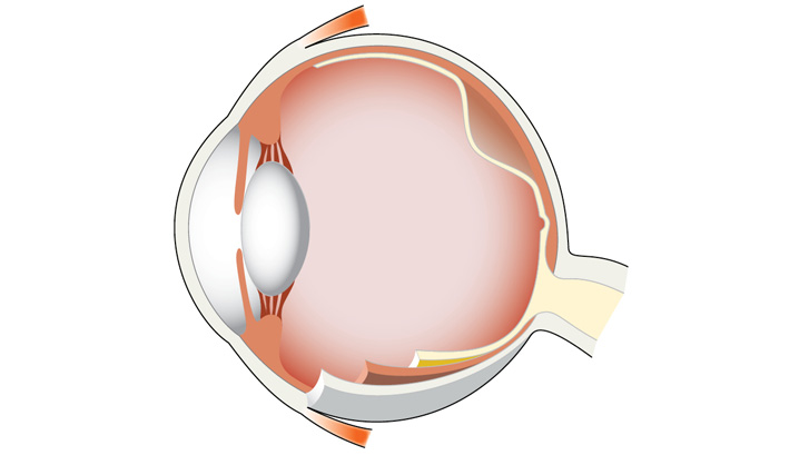 Netthinneløsning innebærer at netthinnen løsner fra festene sine mot årehinnen.