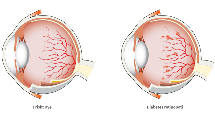Diabetesretinopati kan skape blødninger i netthinnen.